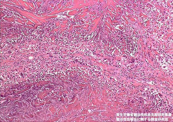 好酸球性多発血管炎性肉芽腫症（Churg-Strauss症候群）（Wegener肉芽腫症）(1)